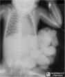 Gastroschisis